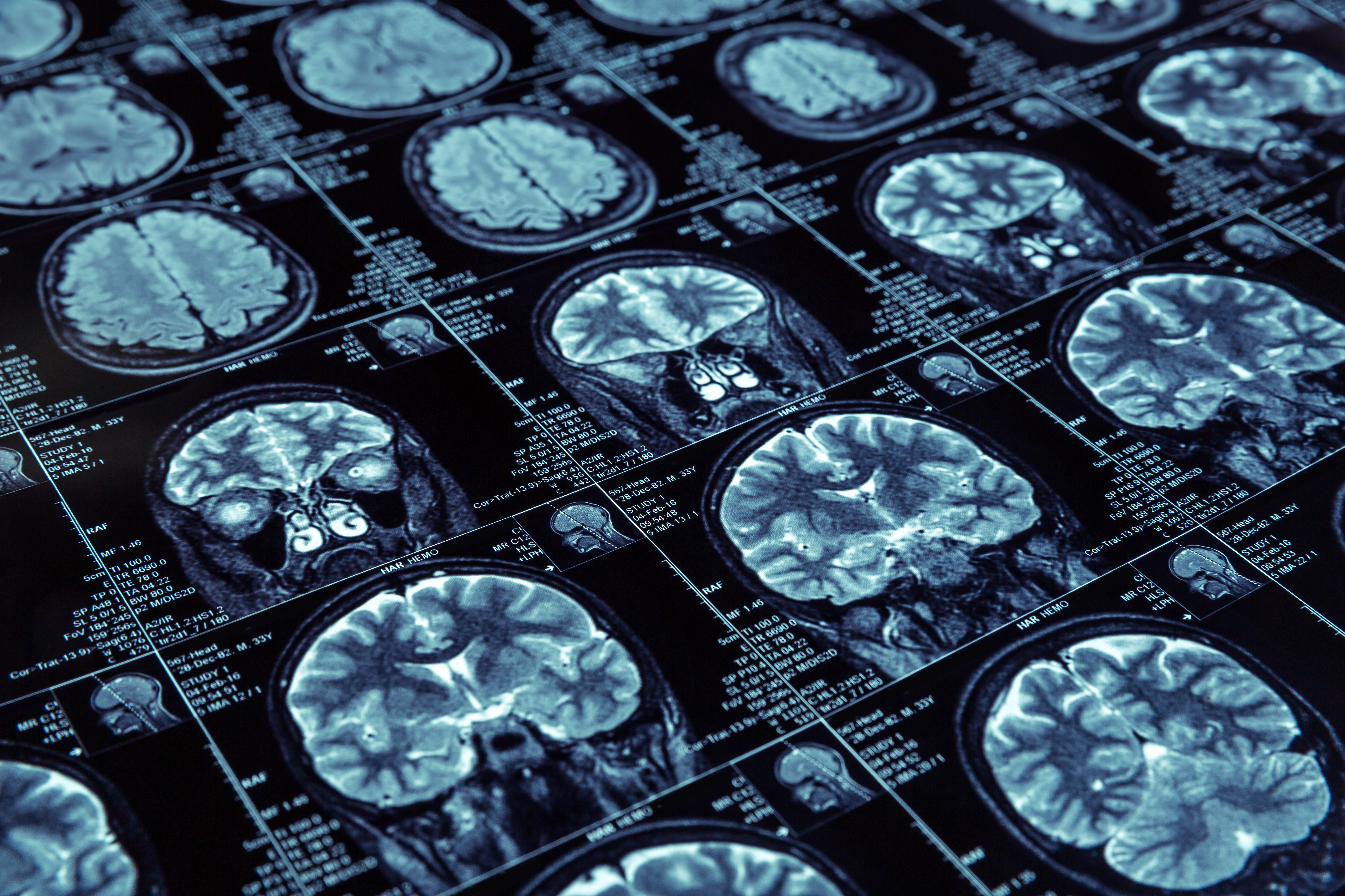 Depression relief in days: the Stanford SAINT breakthrough